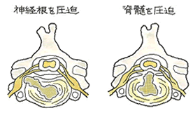 頚椎で神経根が圧迫されている様子を図示しています。