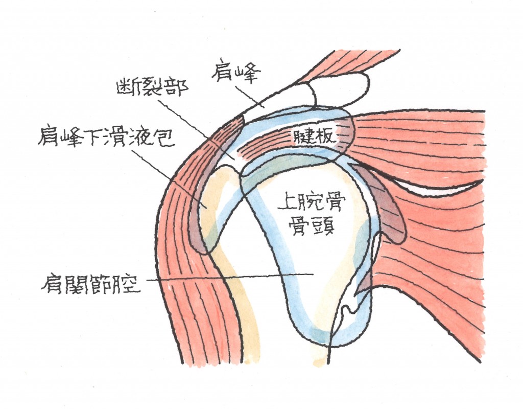 肩腱板断裂