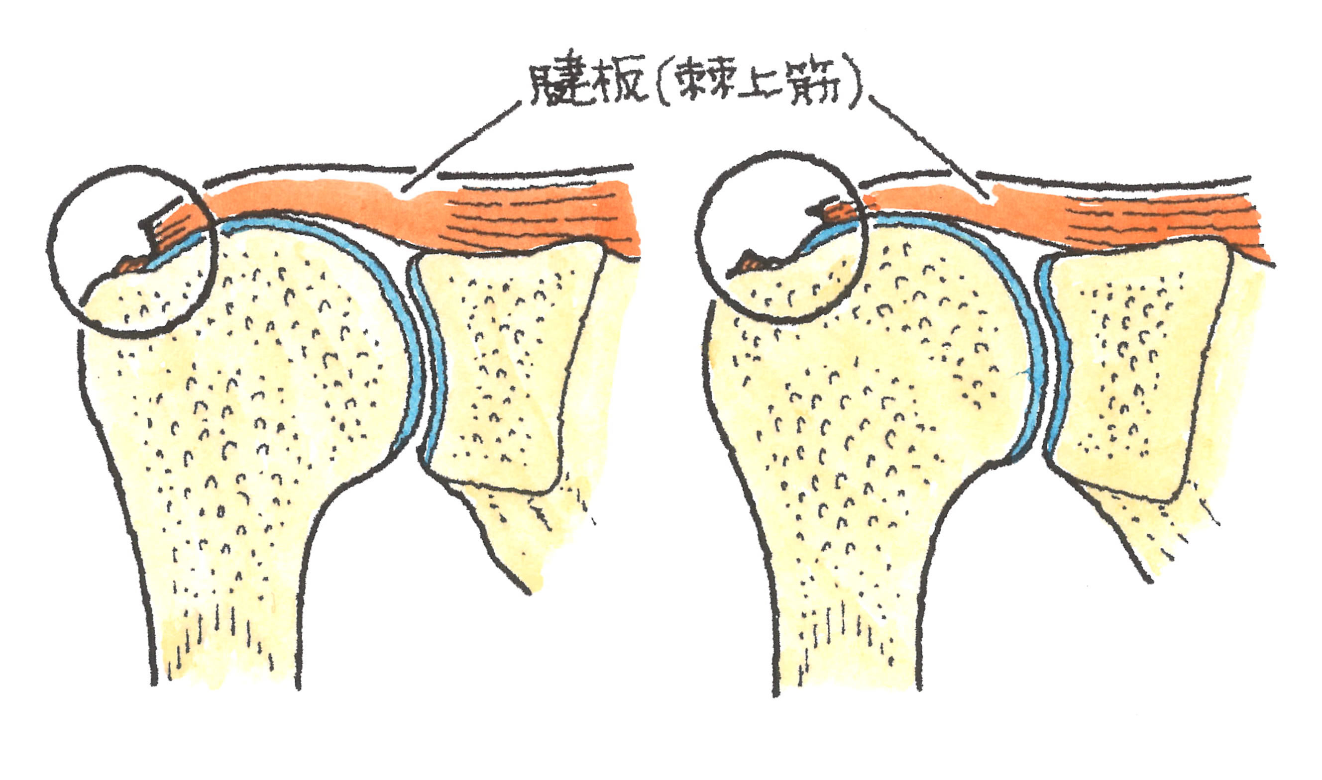 肩腱板断裂(部分断裂と完全断裂)