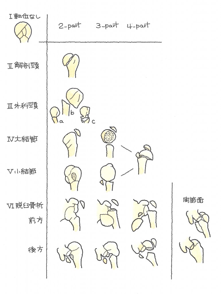 上腕骨近位端骨折２