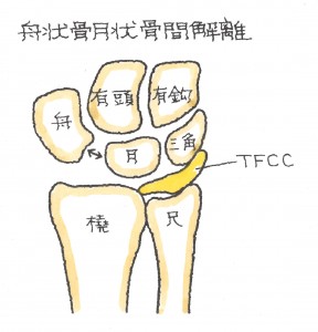 手根骨の骨折　.舟状・月状骨間解離