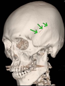 頭部外傷　左側頭骨骨折・脳挫傷