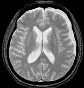 頭部外傷　急性硬膜下血腫